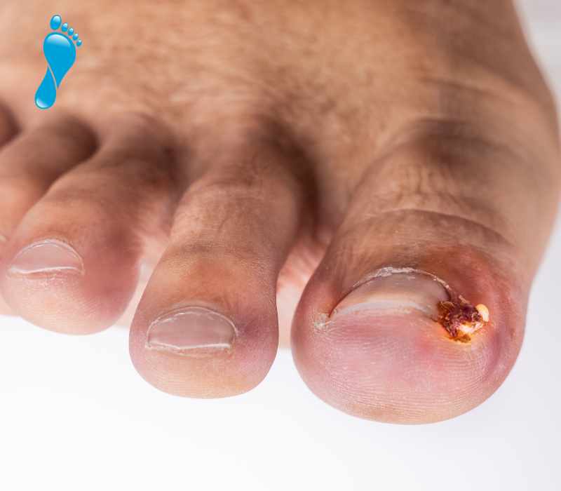 Common foot complaints - In-growing toenails