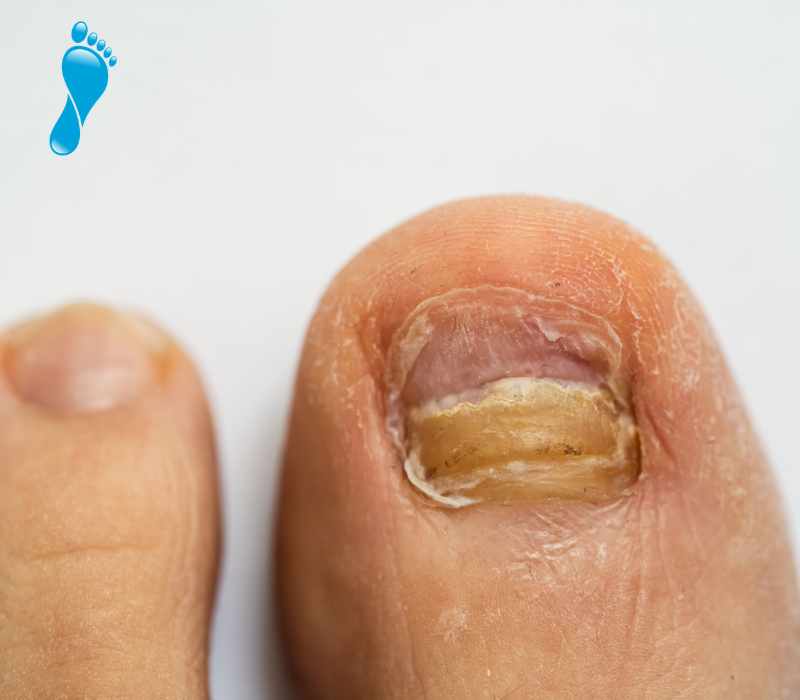 Common foot complaints - damaged, deformed nails