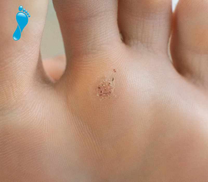 Common foot complaints - verruca's