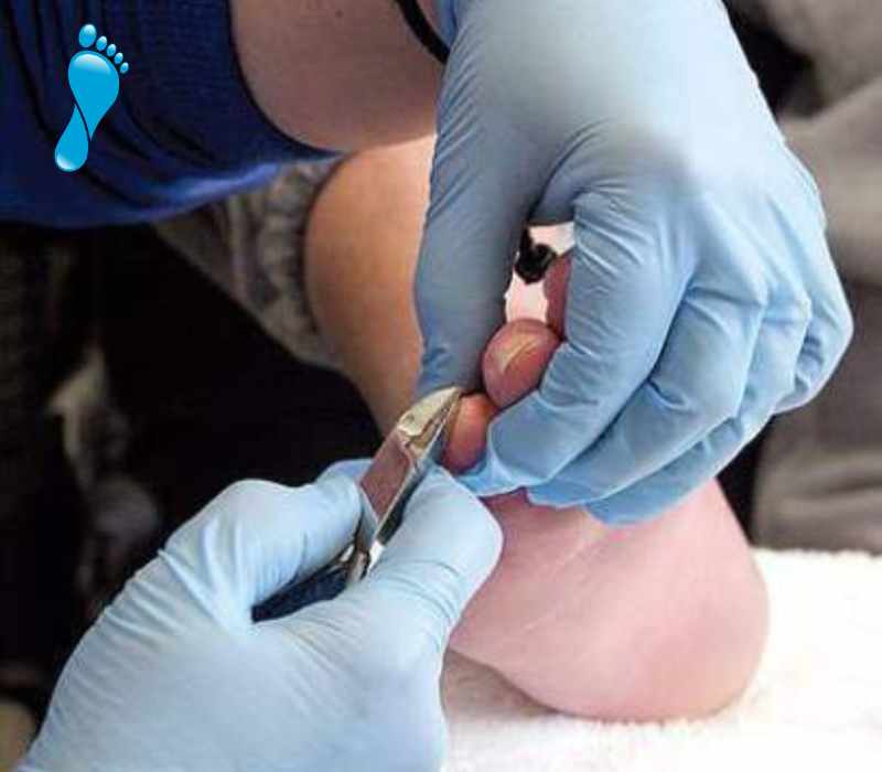 Common foot problems, thick or difficult to reach nails