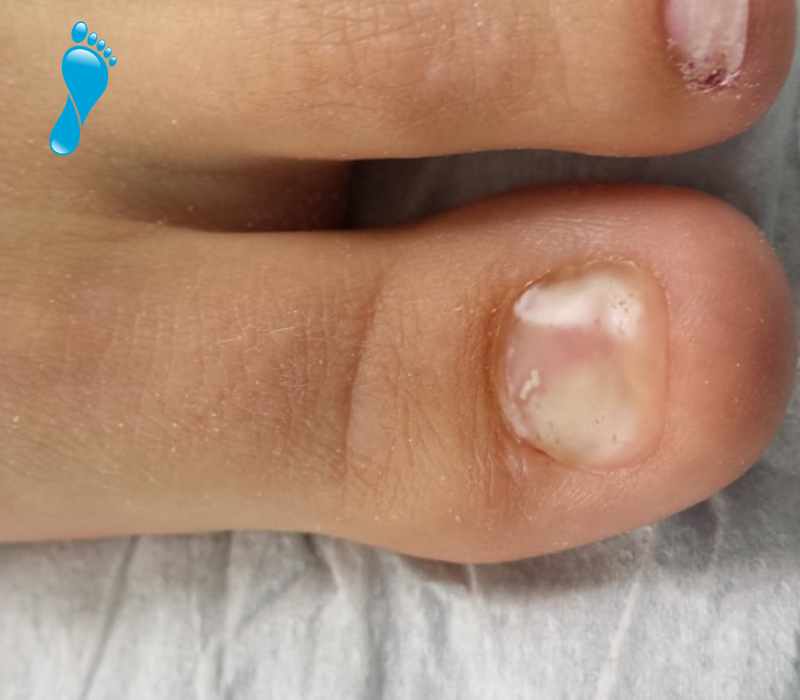 Jo Penny Toe nail reconstruction