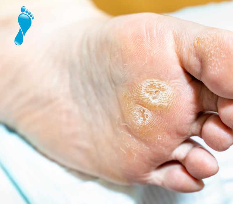 common foot complaints - corns or callouses