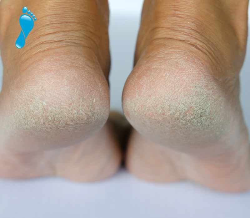 common foot complaints - cracked heels