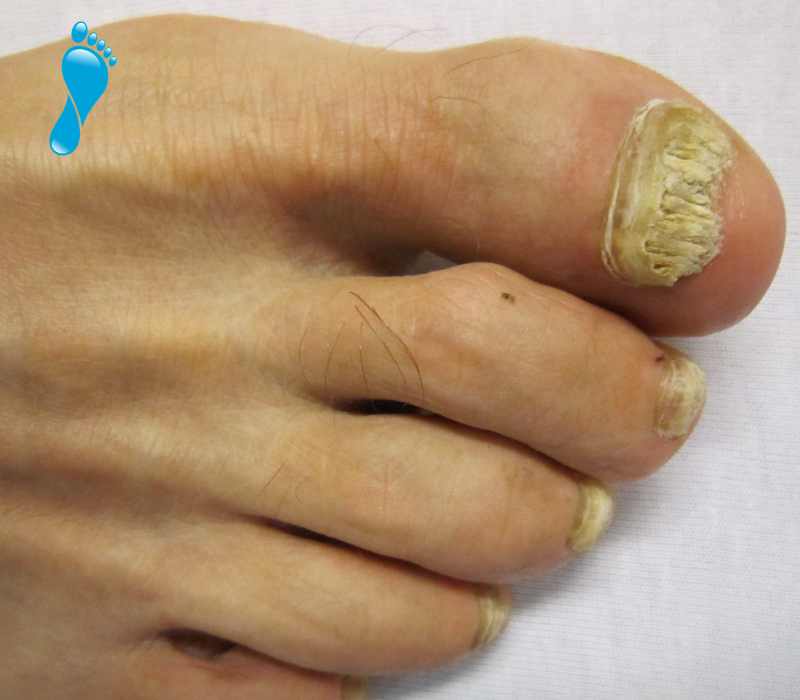 common foot complaints - discoloured, thick, smelly nails